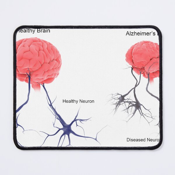 Item preview, STK701304H-A healthy brain compared to a brain with alzheimer's. designed and sold by StocktrekImages.