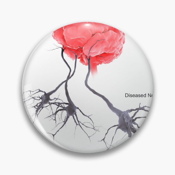 Item preview, STK701305H-A brain with alzheimer's disease, showing diseased neuron. designed and sold by StocktrekImages.