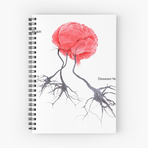 Item preview, STK701305H-A brain with alzheimer's disease, showing diseased neuron. designed and sold by StocktrekImages.