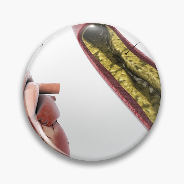 Item preview, STK701306H-Atherosclerotic plaque in the artery. designed and sold by StocktrekImages.