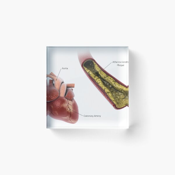 Item preview, STK701306H-Atherosclerotic plaque in the artery. designed and sold by StocktrekImages.