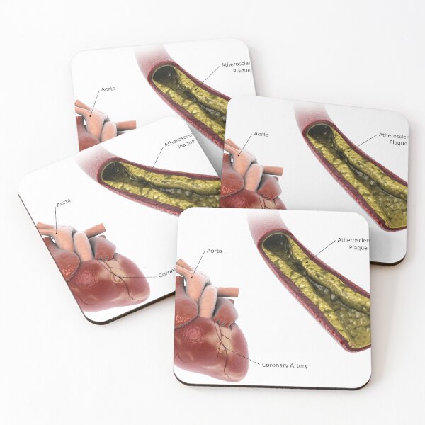 Item preview, STK701306H-Atherosclerotic plaque in the artery. designed and sold by StocktrekImages.