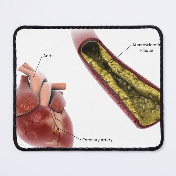 Item preview, STK701306H-Atherosclerotic plaque in the artery. designed and sold by StocktrekImages.