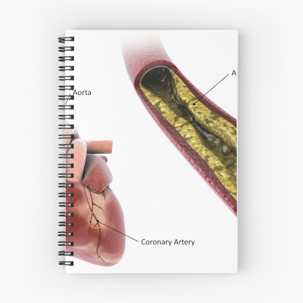 Item preview, STK701306H-Atherosclerotic plaque in the artery. designed and sold by StocktrekImages.