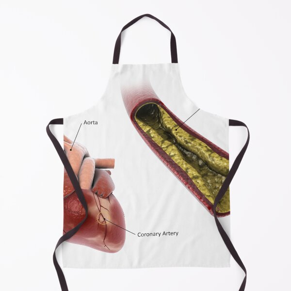 Item preview, STK701306H-Atherosclerotic plaque in the artery. designed and sold by StocktrekImages.