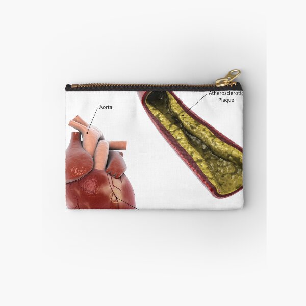 Item preview, STK701306H-Atherosclerotic plaque in the artery. designed and sold by StocktrekImages.