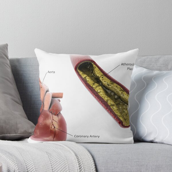 Item preview, STK701306H-Atherosclerotic plaque in the artery. designed and sold by StocktrekImages.