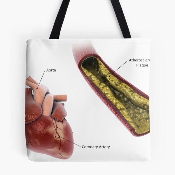 Item preview, STK701306H-Atherosclerotic plaque in the artery. designed and sold by StocktrekImages.