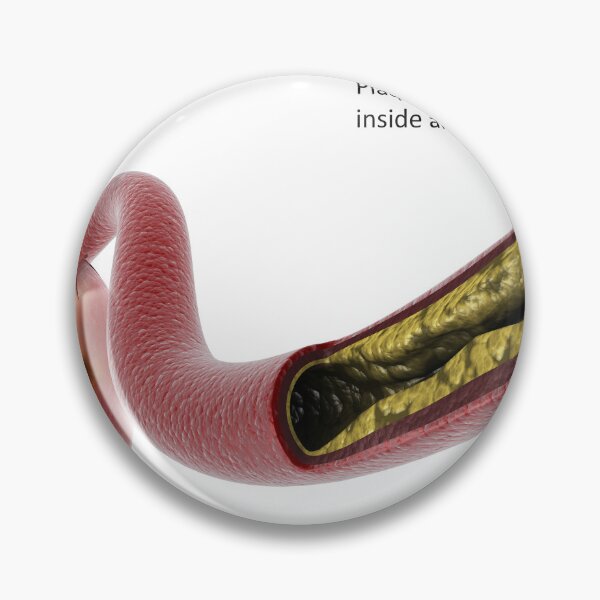 Item preview, STK701308H-Plaque build-up in the artery, leading to a heart attack. designed and sold by StocktrekImages.