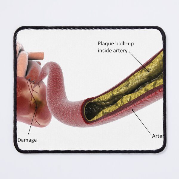 Item preview, STK701308H-Plaque build-up in the artery, leading to a heart attack. designed and sold by StocktrekImages.