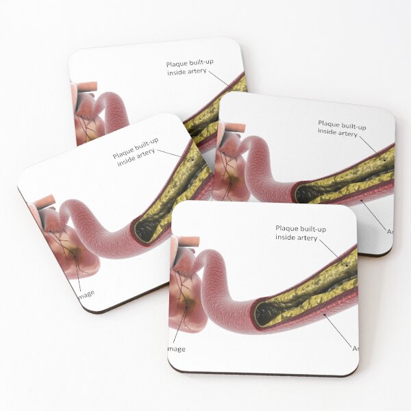 Item preview, STK701308H-Plaque build-up in the artery, leading to a heart attack. designed and sold by StocktrekImages.
