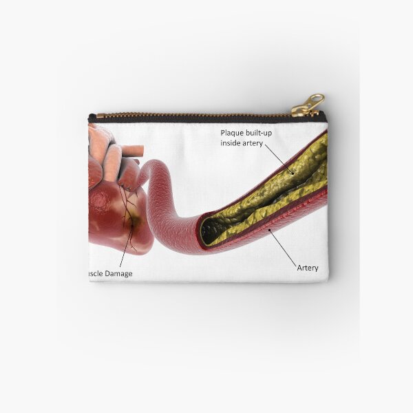 Item preview, STK701308H-Plaque build-up in the artery, leading to a heart attack. designed and sold by StocktrekImages.