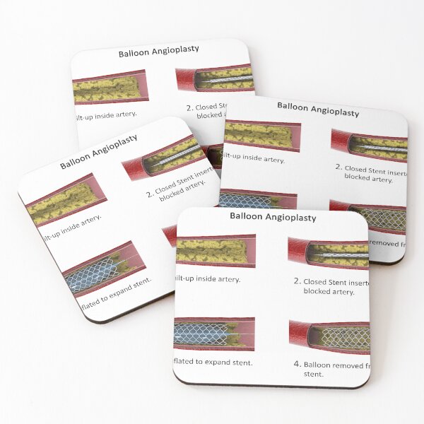 Item preview, STK701309H-Procedure of balloon angioplasty. designed and sold by StocktrekImages.