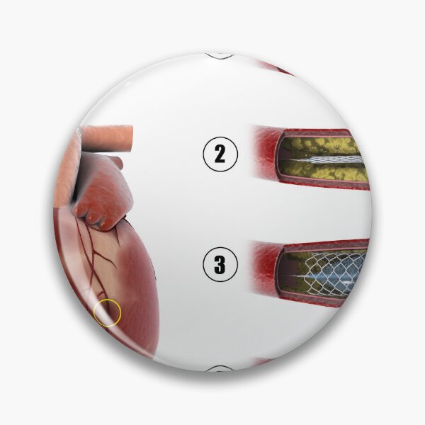 Item preview, STK701310H-Procedure of balloon angioplasty. designed and sold by StocktrekImages.