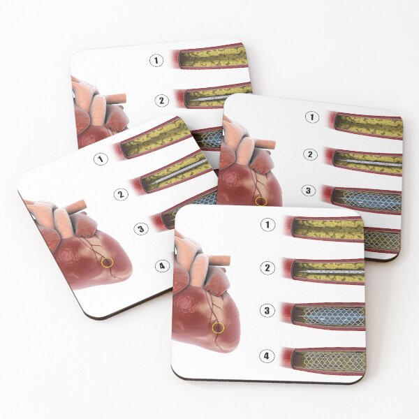 Item preview, STK701310H-Procedure of balloon angioplasty. designed and sold by StocktrekImages.