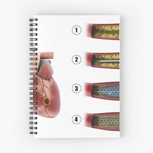 Item preview, STK701310H-Procedure of balloon angioplasty. designed and sold by StocktrekImages.
