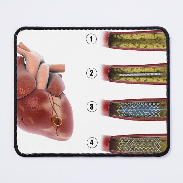 Item preview, STK701310H-Procedure of balloon angioplasty. designed and sold by StocktrekImages.