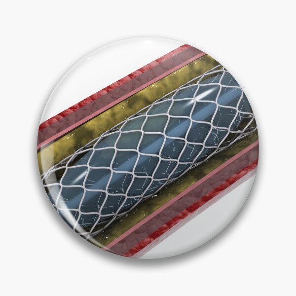 Item preview, STK701311H-Artery showing angioplasty and stent deployment. designed and sold by StocktrekImages.