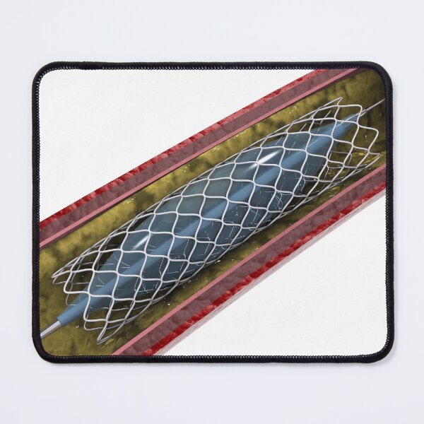 Item preview, STK701311H-Artery showing angioplasty and stent deployment. designed and sold by StocktrekImages.