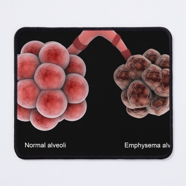 Item preview, STK701315H-Healthy alveoli and an unhealthy emphysema alveoli. designed and sold by StocktrekImages.