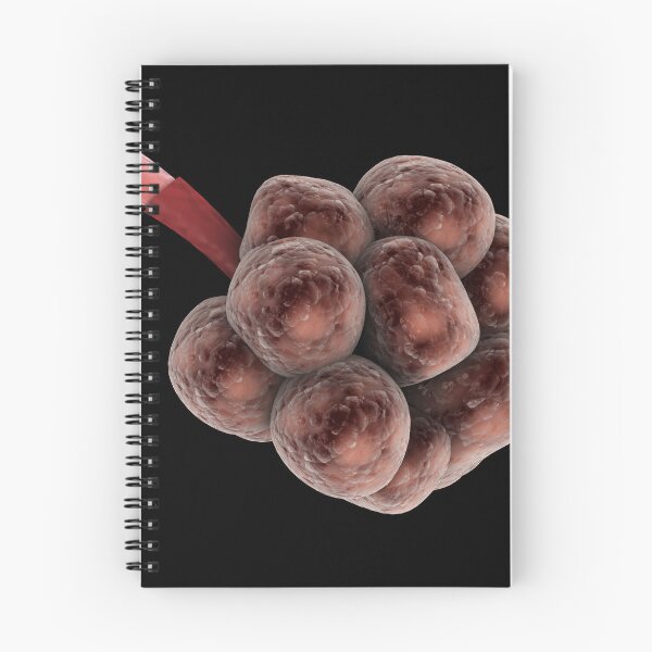 Item preview, STK701316H-Emphysema in the alveoli. designed and sold by StocktrekImages.