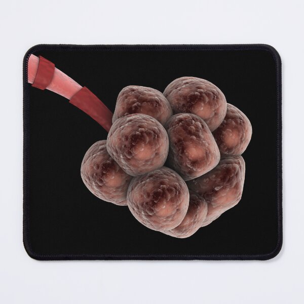 Item preview, STK701316H-Emphysema in the alveoli. designed and sold by StocktrekImages.
