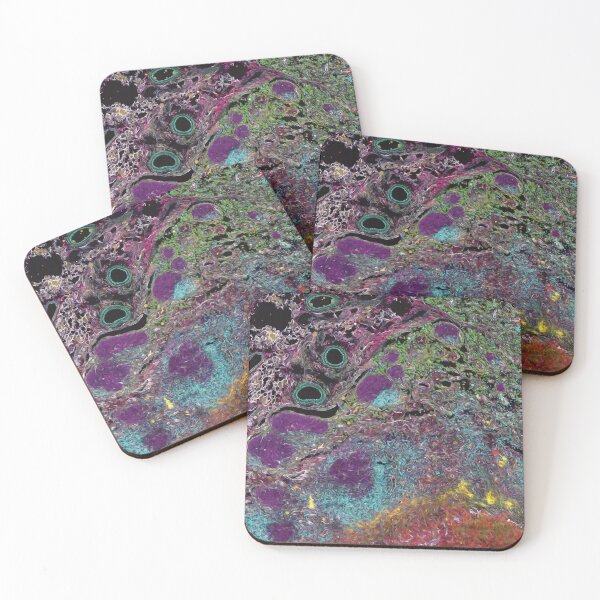 Item preview, Rainbow of infection: Lymph node with an abscess designed and sold by DreamingBeetle.