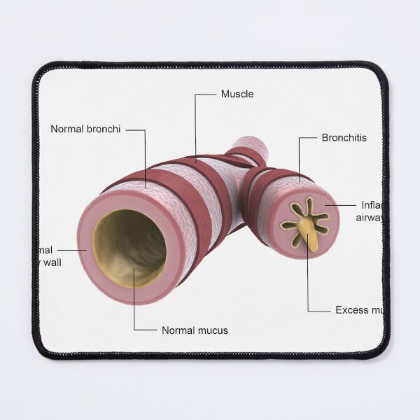 Item preview, STK701319H-Bronchitis. designed and sold by StocktrekImages.