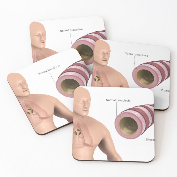 Item preview, STK701320H-Bronchitis in human lungs. designed and sold by StocktrekImages.
