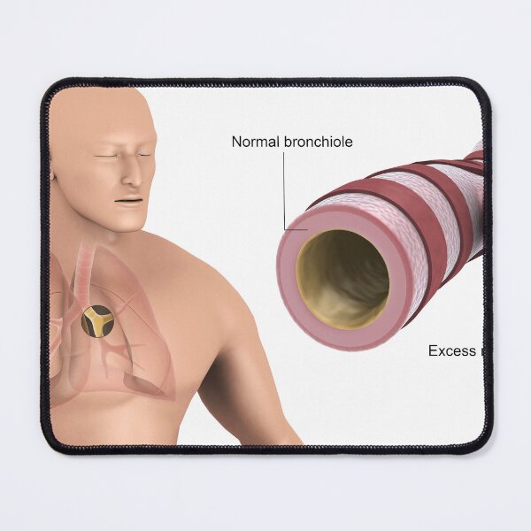 Item preview, STK701320H-Bronchitis in human lungs. designed and sold by StocktrekImages.