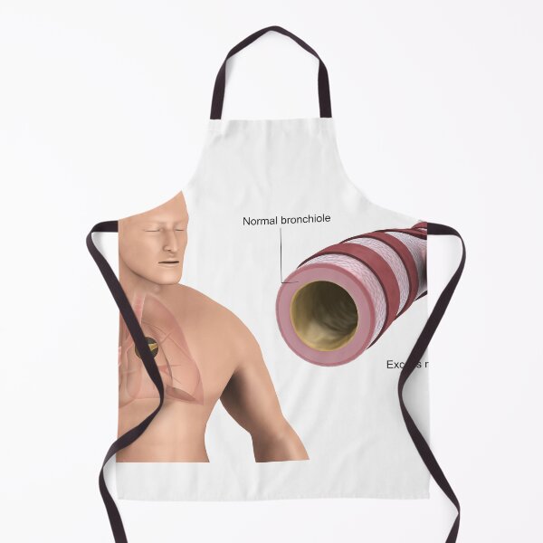 Item preview, STK701320H-Bronchitis in human lungs. designed and sold by StocktrekImages.