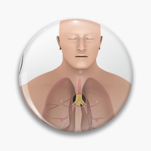 Item preview, STK701321H-Bronchitis in human lungs. designed and sold by StocktrekImages.