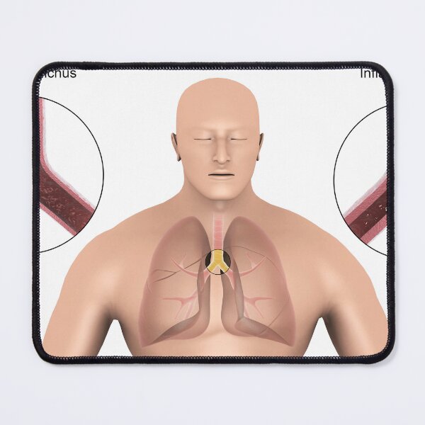 Item preview, STK701321H-Bronchitis in human lungs. designed and sold by StocktrekImages.