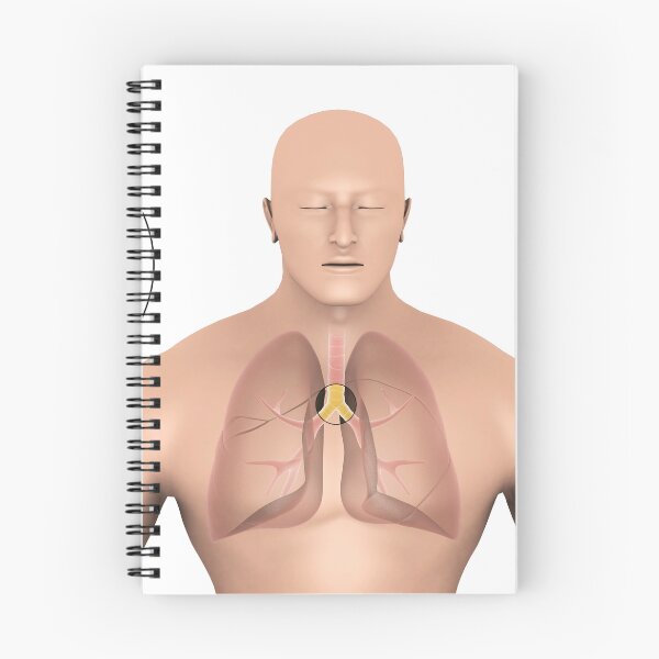 Item preview, STK701321H-Bronchitis in human lungs. designed and sold by StocktrekImages.