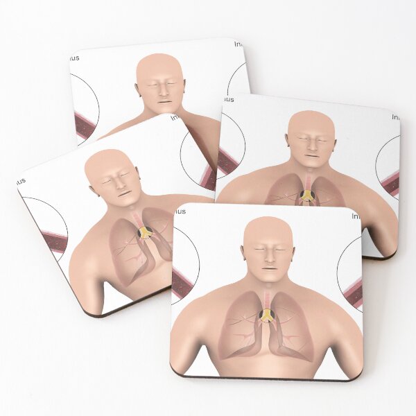 Item preview, STK701321H-Bronchitis in human lungs. designed and sold by StocktrekImages.