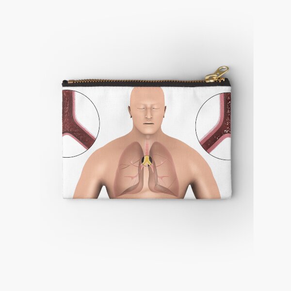 Item preview, STK701321H-Bronchitis in human lungs. designed and sold by StocktrekImages.