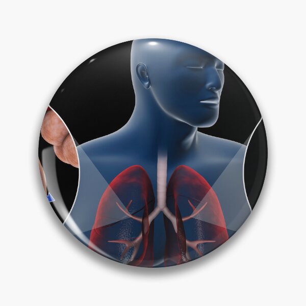 Item preview, STK701322H-A normal bronchiole and an asthmatic bronchiole. designed and sold by StocktrekImages.