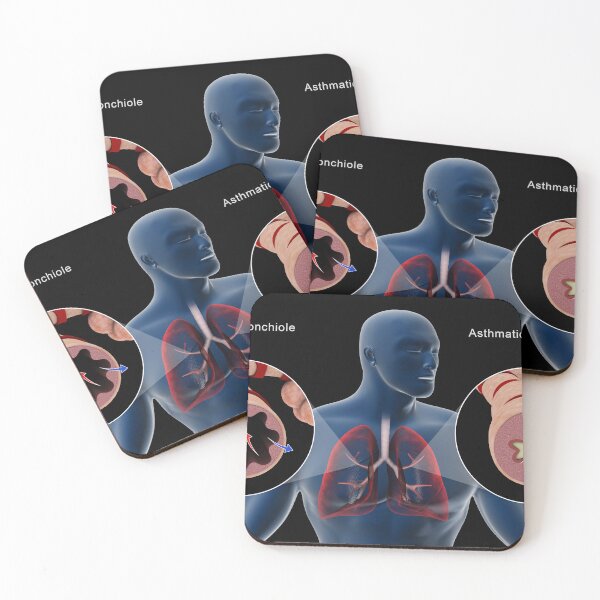 Item preview, STK701322H-A normal bronchiole and an asthmatic bronchiole. designed and sold by StocktrekImages.