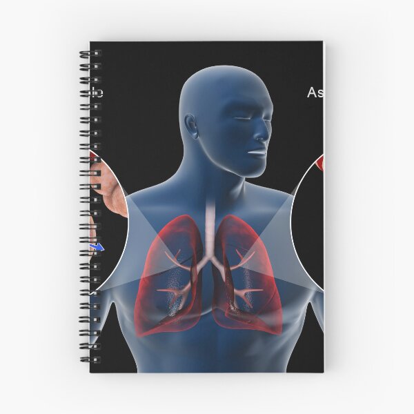 Item preview, STK701322H-A normal bronchiole and an asthmatic bronchiole. designed and sold by StocktrekImages.
