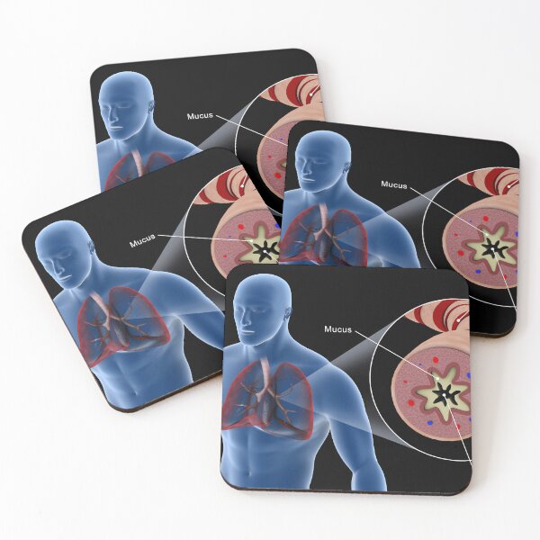 Item preview, STK701323H-An asthmatic bronchiole in the human respiratory tract. designed and sold by StocktrekImages.