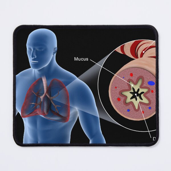 Item preview, STK701323H-An asthmatic bronchiole in the human respiratory tract. designed and sold by StocktrekImages.