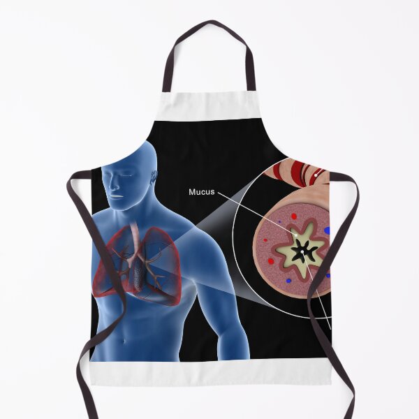 Item preview, STK701323H-An asthmatic bronchiole in the human respiratory tract. designed and sold by StocktrekImages.