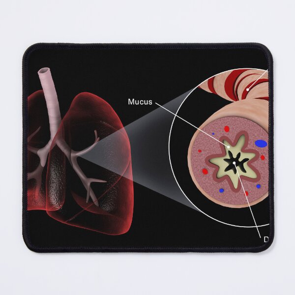 Item preview, STK701324H-An asthmatic bronchiole in the human lungs. designed and sold by StocktrekImages.