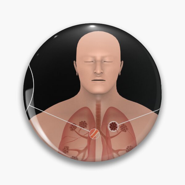 Item preview, STK701325H-Chronic Obstructive Pulmonary Disease (COPD). designed and sold by StocktrekImages.
