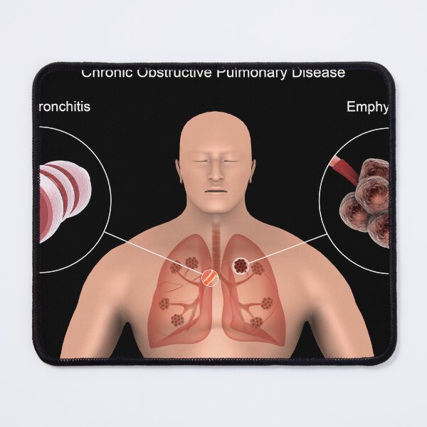 Item preview, STK701325H-Chronic Obstructive Pulmonary Disease (COPD). designed and sold by StocktrekImages.