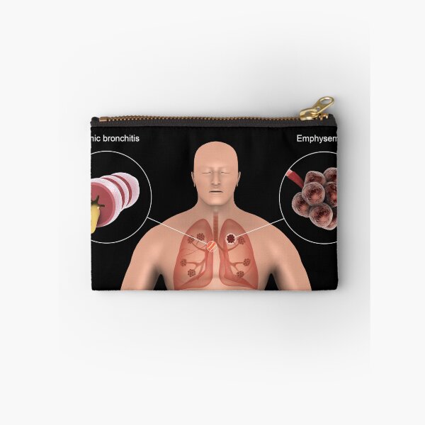 Item preview, STK701325H-Chronic Obstructive Pulmonary Disease (COPD). designed and sold by StocktrekImages.