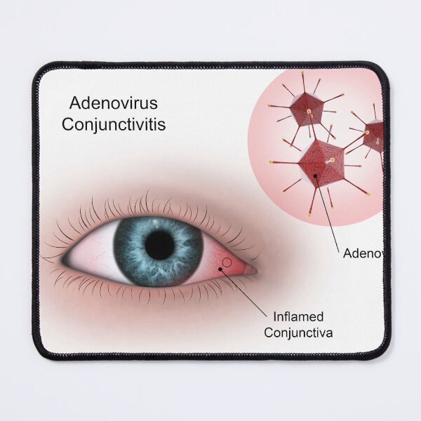 Item preview, STK701344H-Viral conjunctivitis in the eye designed and sold by StocktrekImages.