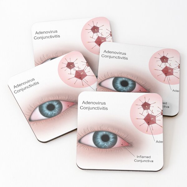 Item preview, STK701344H-Viral conjunctivitis in the eye designed and sold by StocktrekImages.