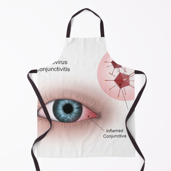 Item preview, STK701344H-Viral conjunctivitis in the eye designed and sold by StocktrekImages.
