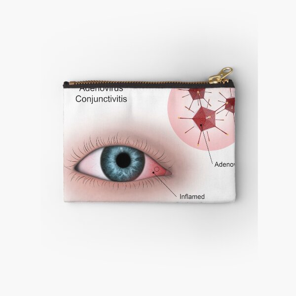 Item preview, STK701344H-Viral conjunctivitis in the eye designed and sold by StocktrekImages.